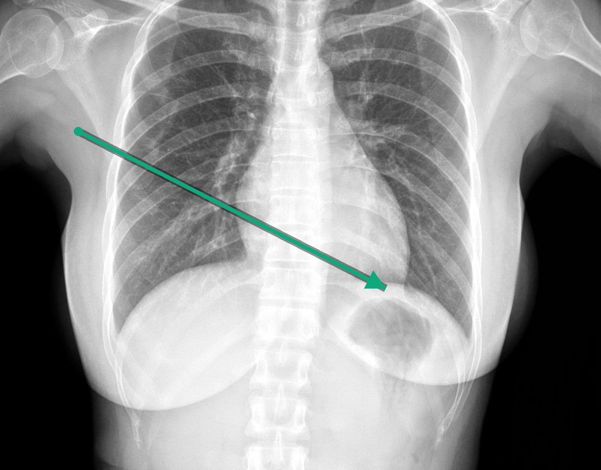 Chest radiograph with a line from the right axilla to the left ventricular apex, showing the straight approach axis