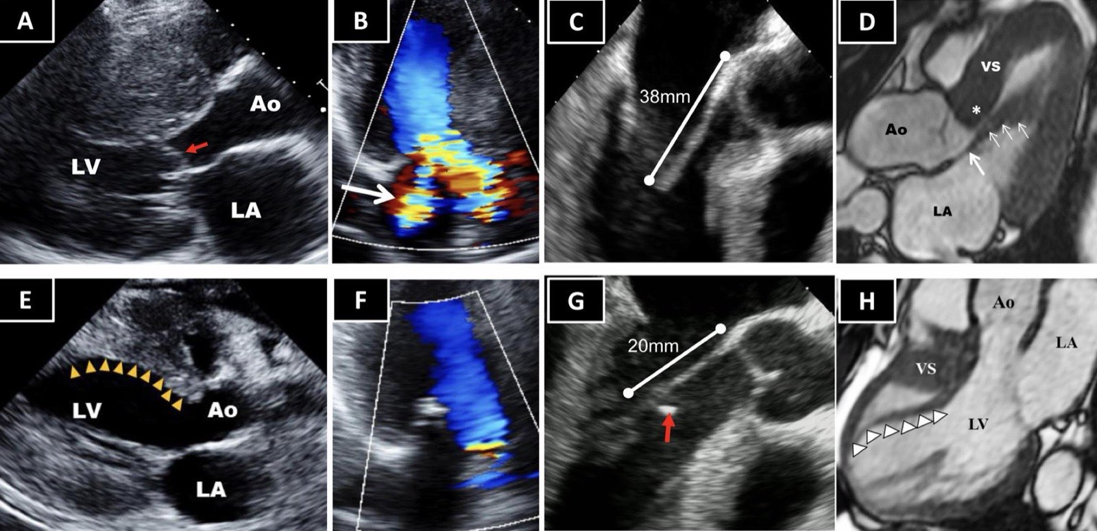 Echocardiographic and MRI images before and after minimally invasive septal myectomy, showing septal thickness reduced from 38 mm to 20 mm