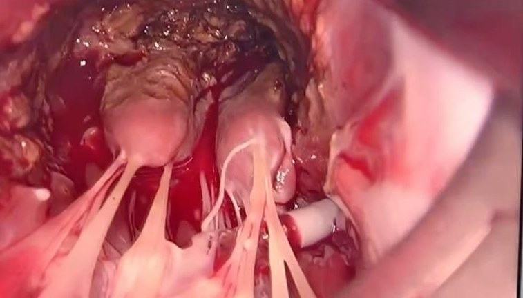 Intracardiac view of the left ventricle showing papillary muscles and chordae after septal resection