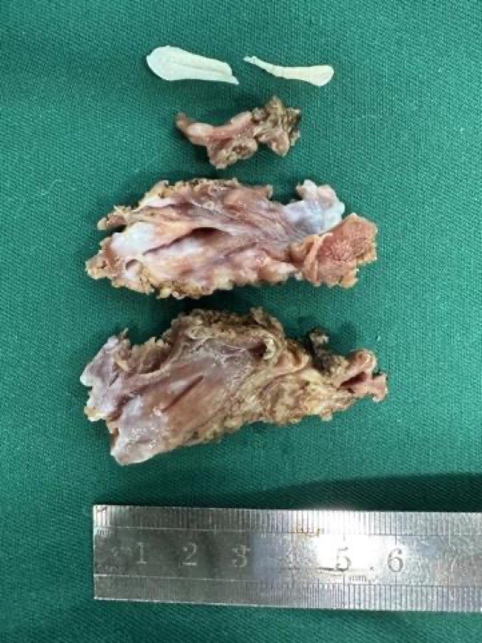 Resected septal muscle specimens photographed beside a centimetre ruler